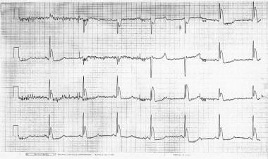 Osborne (J) waves (V3) in a patient with a rectal 