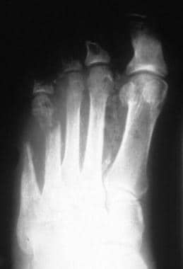 Osteomyelitis. Radiography of diabetic foot showin