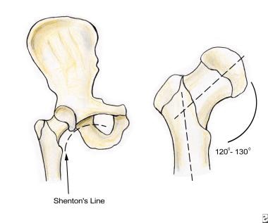 Shenton line and angular anatomy of the femur. 