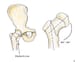 Hip Fracture in the ED