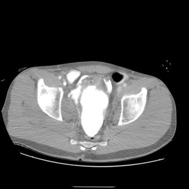 Ruptured urinary bladder detected by CT scan. 
