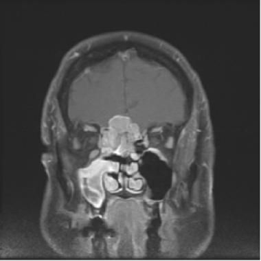 Coronal MRI T1 with contrast showing an esthesione