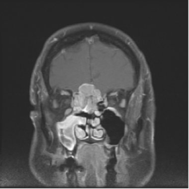 maxillary sinus cancer