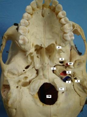 External aspect of the skull base: carotid canal (
