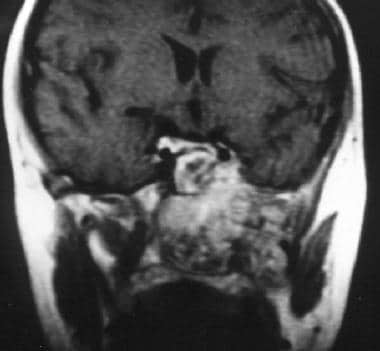 Coronal MRI scan showing extension of the lesion t
