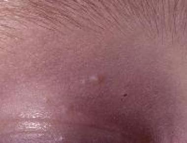 Molluscum contagiosum. Lesions on the upper eyelid