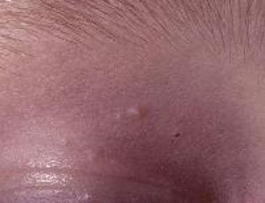 molluscum contagiosum eyelid