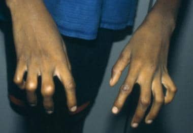 The hands of a patient with contractural arachnoda