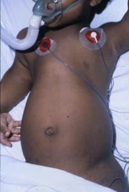 A child with Jeune syndrome. Note long narrow thor