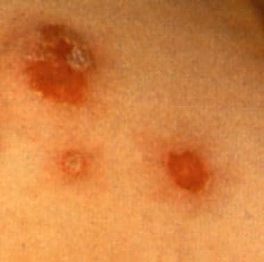 Bullous impetigo with circumscribed lesions with a