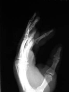 Volar proximal interphalangeal (PIP) joint disloca