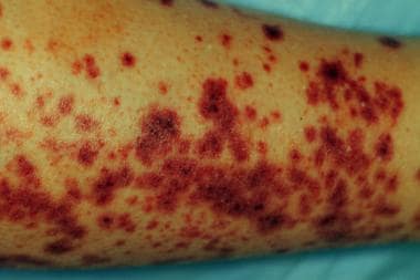 Characteristic rash of IgA vasculitis (Henoch-Schö