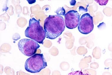 Bone marrow aspirate from a child with B-cell acut