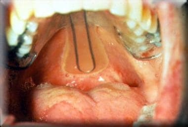 Palatal lift in situ.