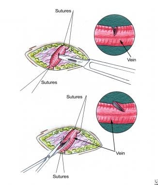 Saphenous vein venotomy. Venotomy is made during s