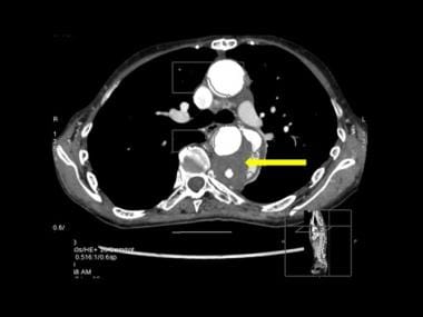 Axial CT scan through the mid-descending aorta in 
