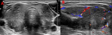 Ultrasonogram of subacute granulomatous thyroiditi