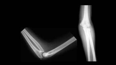 Hip Growth Plate Fracture