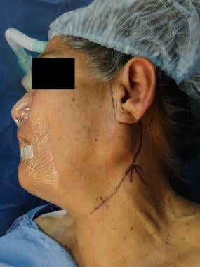 submandibular tumor