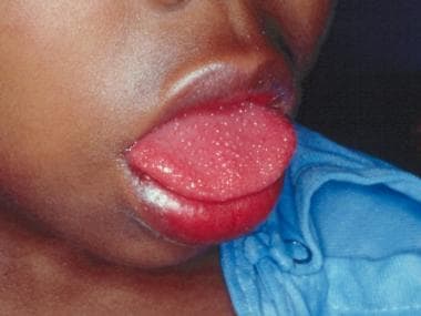 Oral manifestations of Kawasaki disease: red lips 
