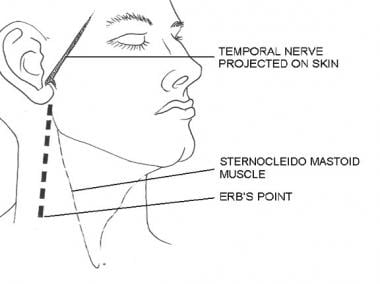 Course of the temporal nerve and location of the E