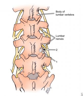 Lumbar paravertebral somatic block technique. See 