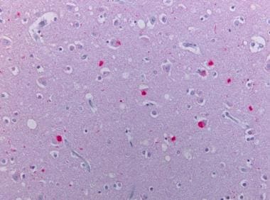 Neocortex stained alpha synuclein. The presence of