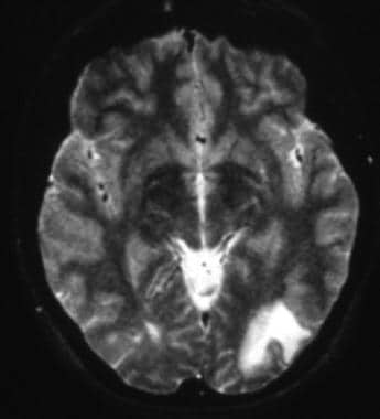 T2-weighted MRI shows left occipital hyperintense 