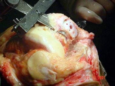 Revision to a total knee arthroplasty. The earlier