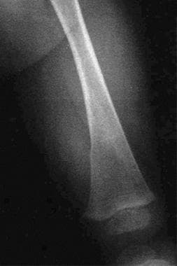 Distal femur fracture due to child abuse. 