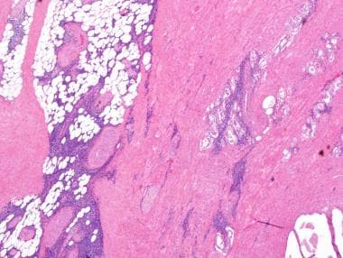 Pathology of Prostate Leukemia and Lymphoma. Margi