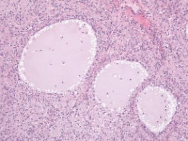 Juvenile granulosa cell tumor shows round-to-oval 