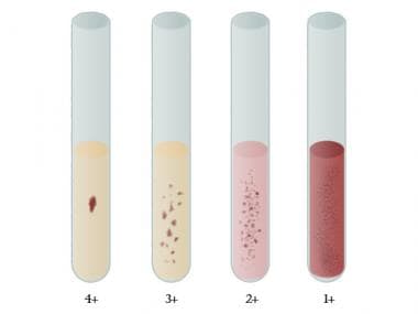 How Does The D Antigen Affect Rhesus Rh Typing