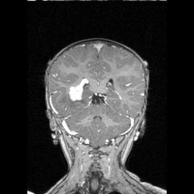 This coronal T1-weighted magnetic resonance image 