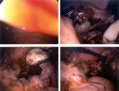 Endometriosis. Chocolate cyst of the ovary. 