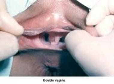 Double vagina. 