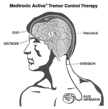 The Medtronics, Inc, Activa Tremor control system 