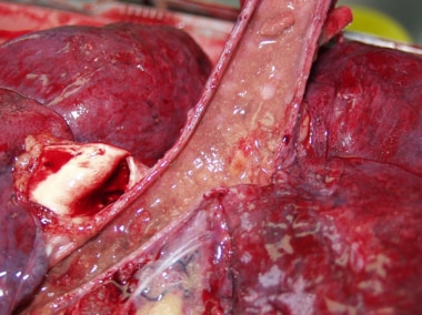 Aspirated food particles present in trachea. There