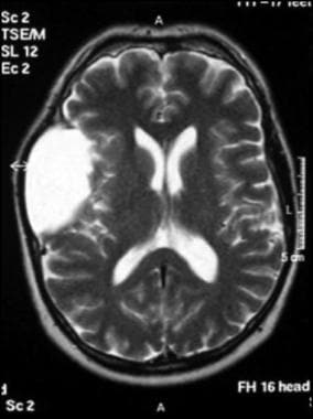Axial T2-weighted MRI image through the body of th