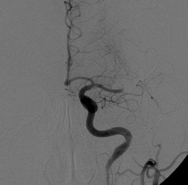 Middle cerebral artery (MCA) occlusion: This patie