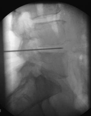 Fluoroscopy-guided radiograph shows how disk aspir