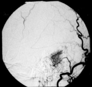 Selective angiogram of right occipital artery show