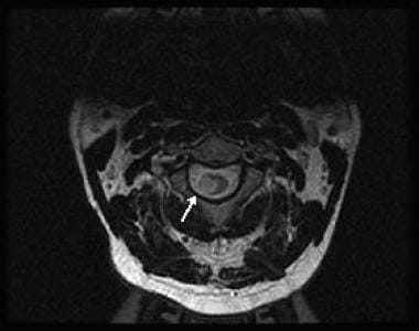 Axial, T2-weighted image showing a large area of s