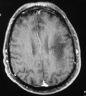 Contrast-enhanced T1-weighted MRI demonstrates a h