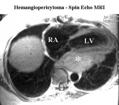 Spin-echo MRI scan in a patient with hemangioperic