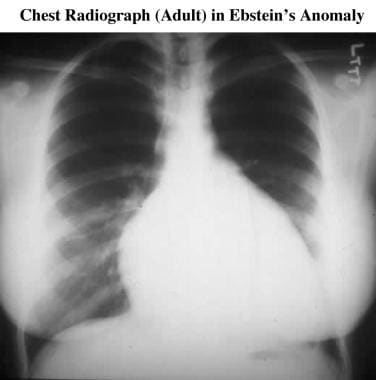 Frontal chest radiograph in an adult with Ebstein 