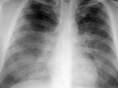 Frontal chest radiograph from a patient with pulmo
