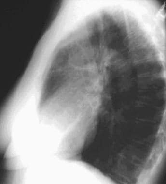 A 65-year-old woman was examined for chronic cough