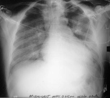 Bilateral spontaneous pneumothoraces resulting fro