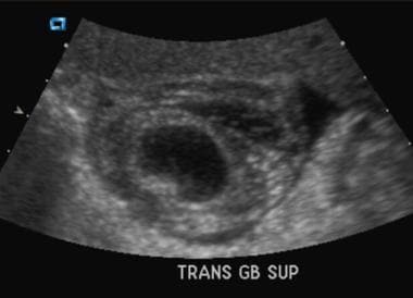 Transverse ultrasonogram demonstrates marked gallb
